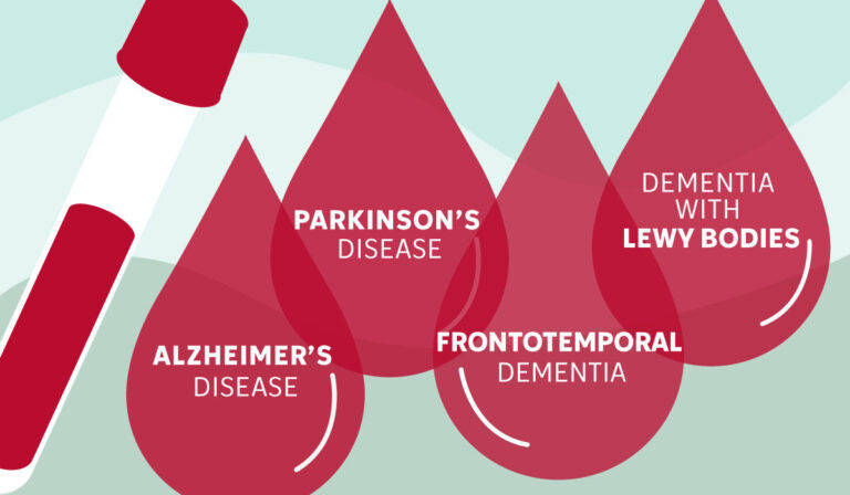 Blood test powered by AI could transform diagnosis of dementia